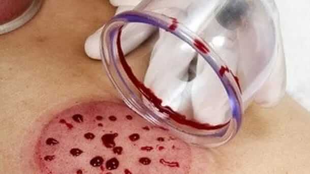 Metode pengobatan Nabi Muhammad SAW